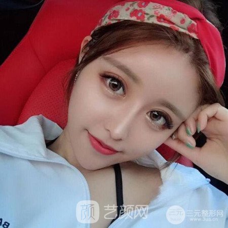 成都銅雀臺雷剛吸脂瘦臉一個(gè)月案例分享~